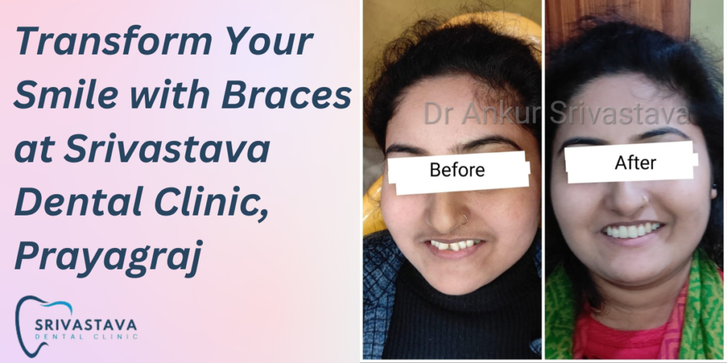 Braces at Srivastava Dental Clinic, Prayagraj