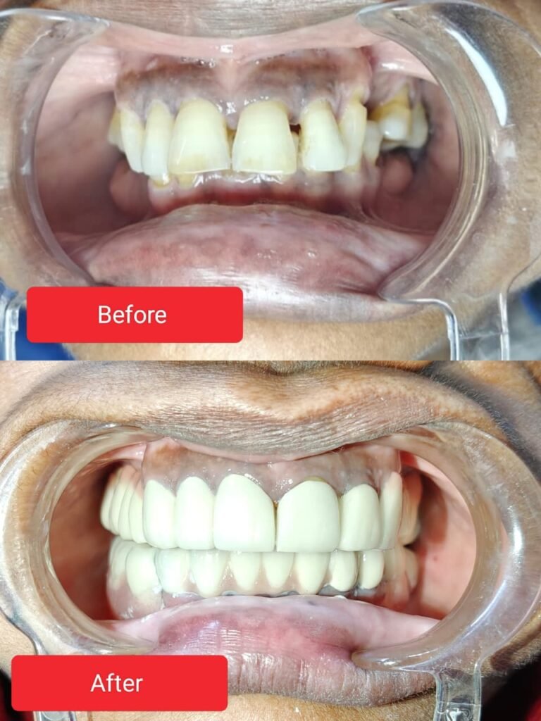 Blogs 44 Allahabad (Prayagraj) Residents Declare Srivastava Dental Clinic as the Best Dental Clinic – A Remarkable Smile Transformation Story