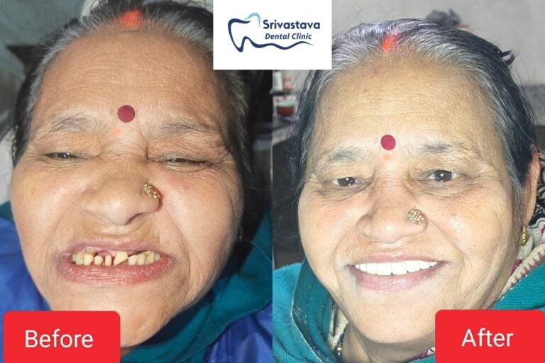 Blogs 39 Full Mouth Rehabilitation in Prayagraj: A Real Smile Transformation by the Best Dental Clinic