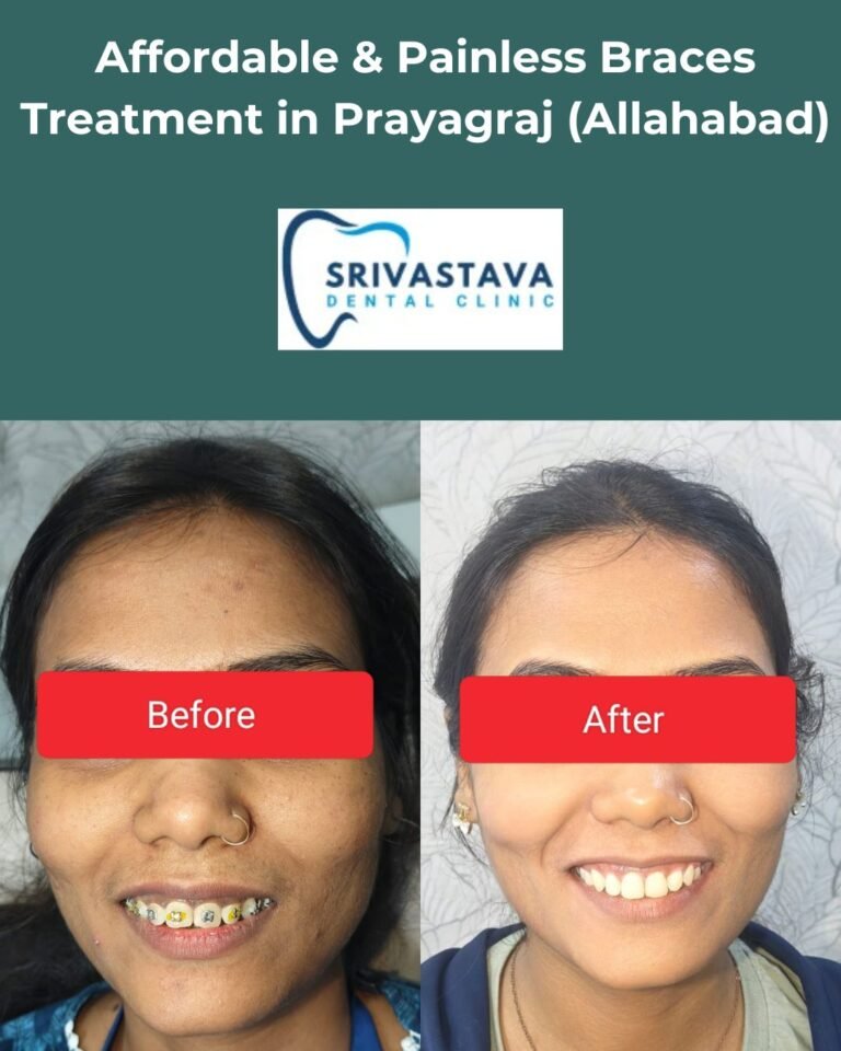 Affordable & Painless Braces Treatment in Prayagraj (Allahabad)