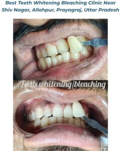 Best Teeth Whitening Bleaching Clinic Near Shiv Nagar, Allahpur, Prayagraj, Uttar Pradesh