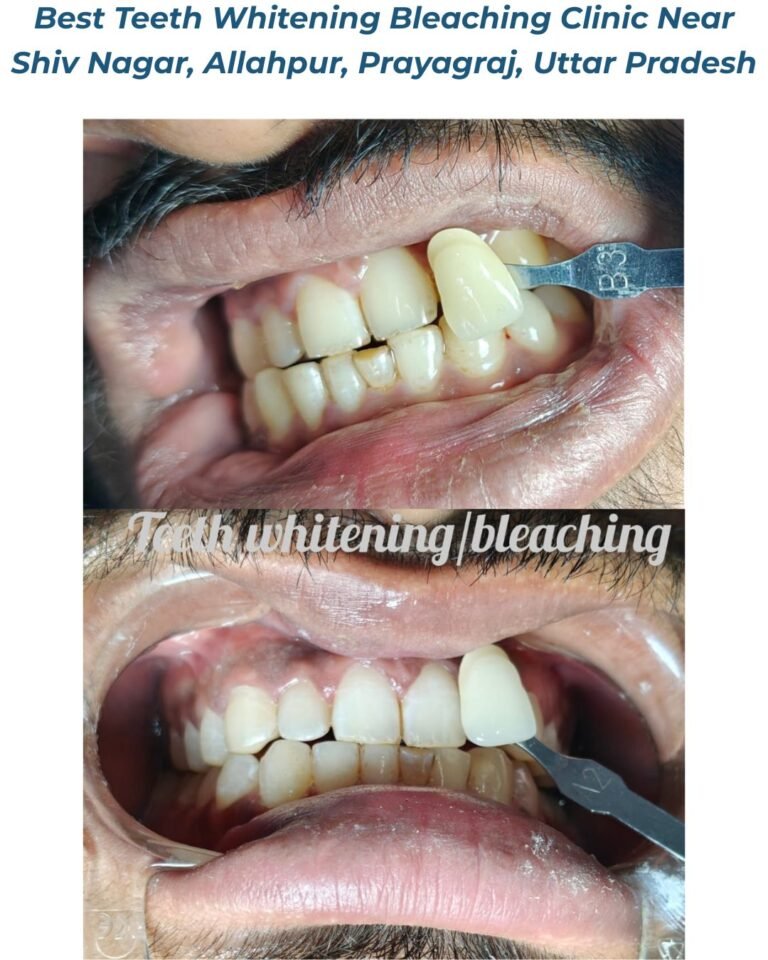 Home 46 Best Teeth Whitening Bleaching Clinic Near Shiv Nagar, Allahpur, Prayagraj, Uttar Pradesh