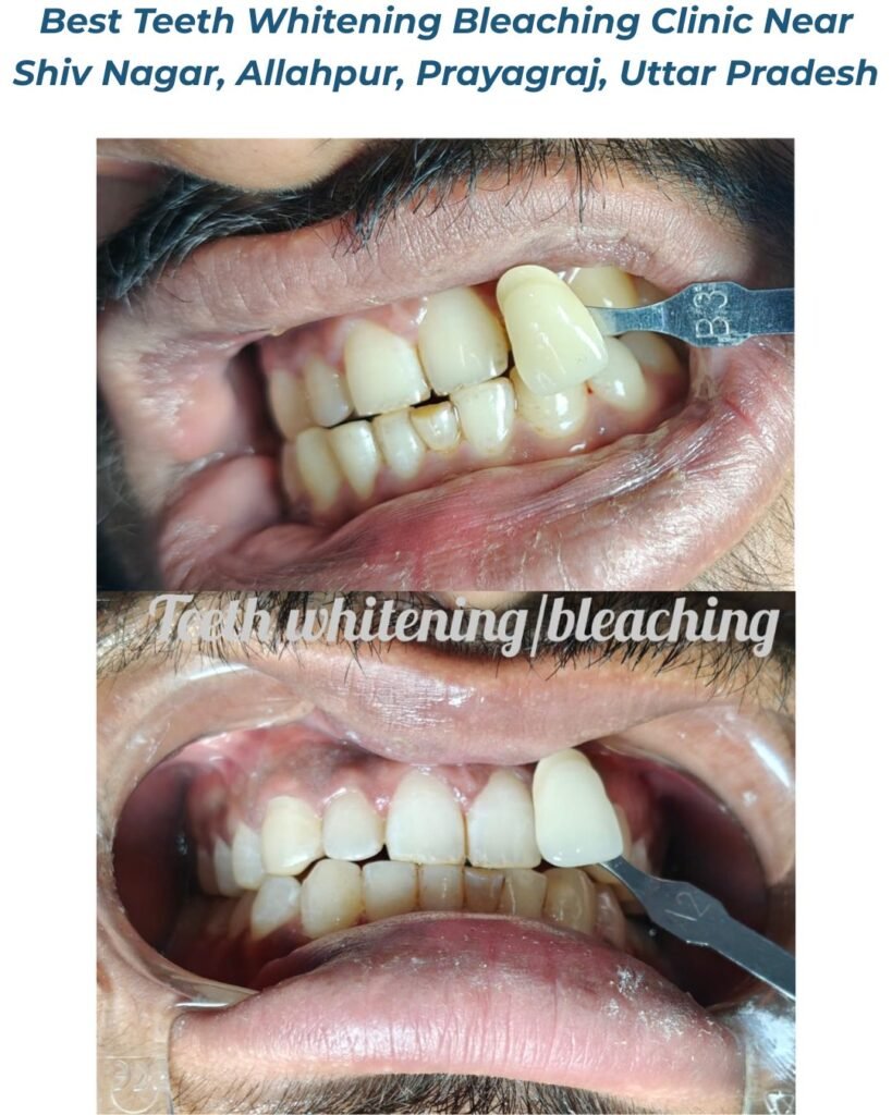 Best Teeth Whitening Bleaching Clinic Near Shiv Nagar, Allahpur, Prayagraj, Uttar Pradesh 1 Best Teeth Whitening Bleaching Clinic Near Shiv Nagar, Allahpur, Prayagraj, Uttar Pradesh